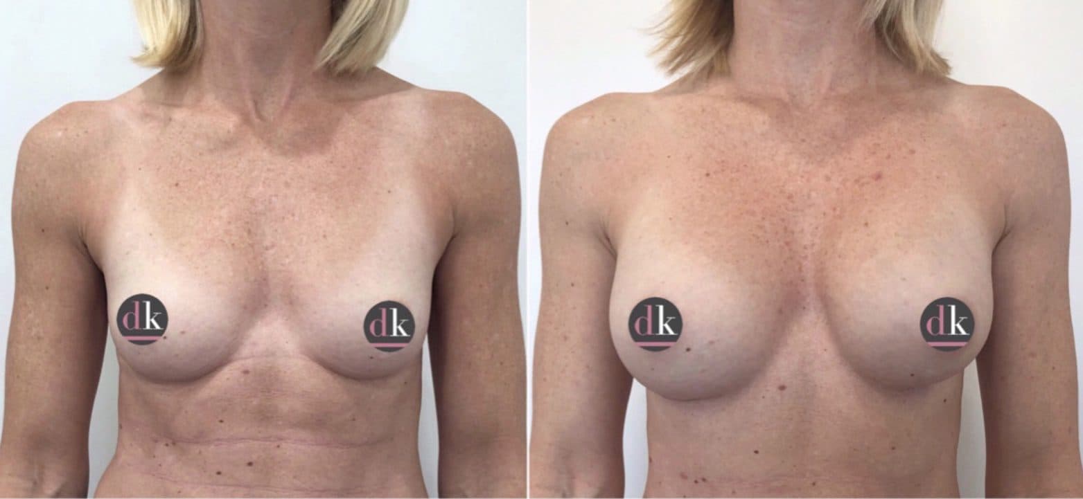 Before and after breast surgery by Dr. Dana Khuthaila, plastic surgeon in New York City — patient 58