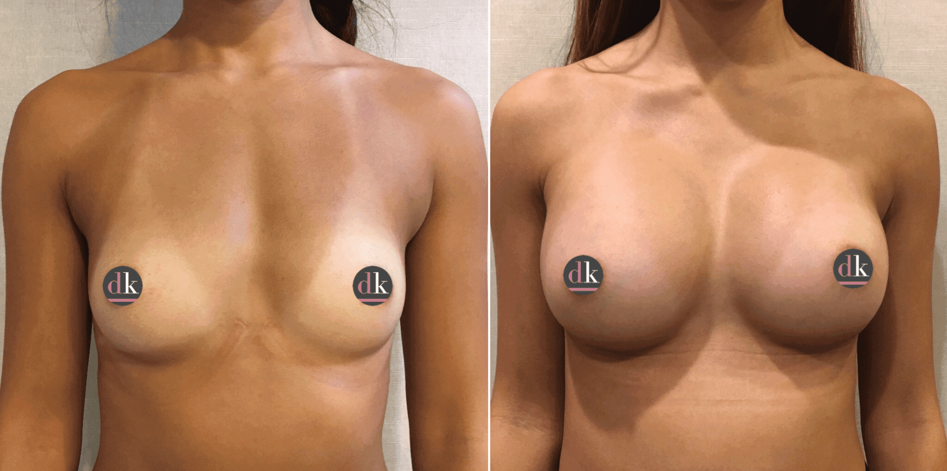 Before and after breast surgery by Dr. Dana Khuthaila, plastic surgeon in New York City — patient 49