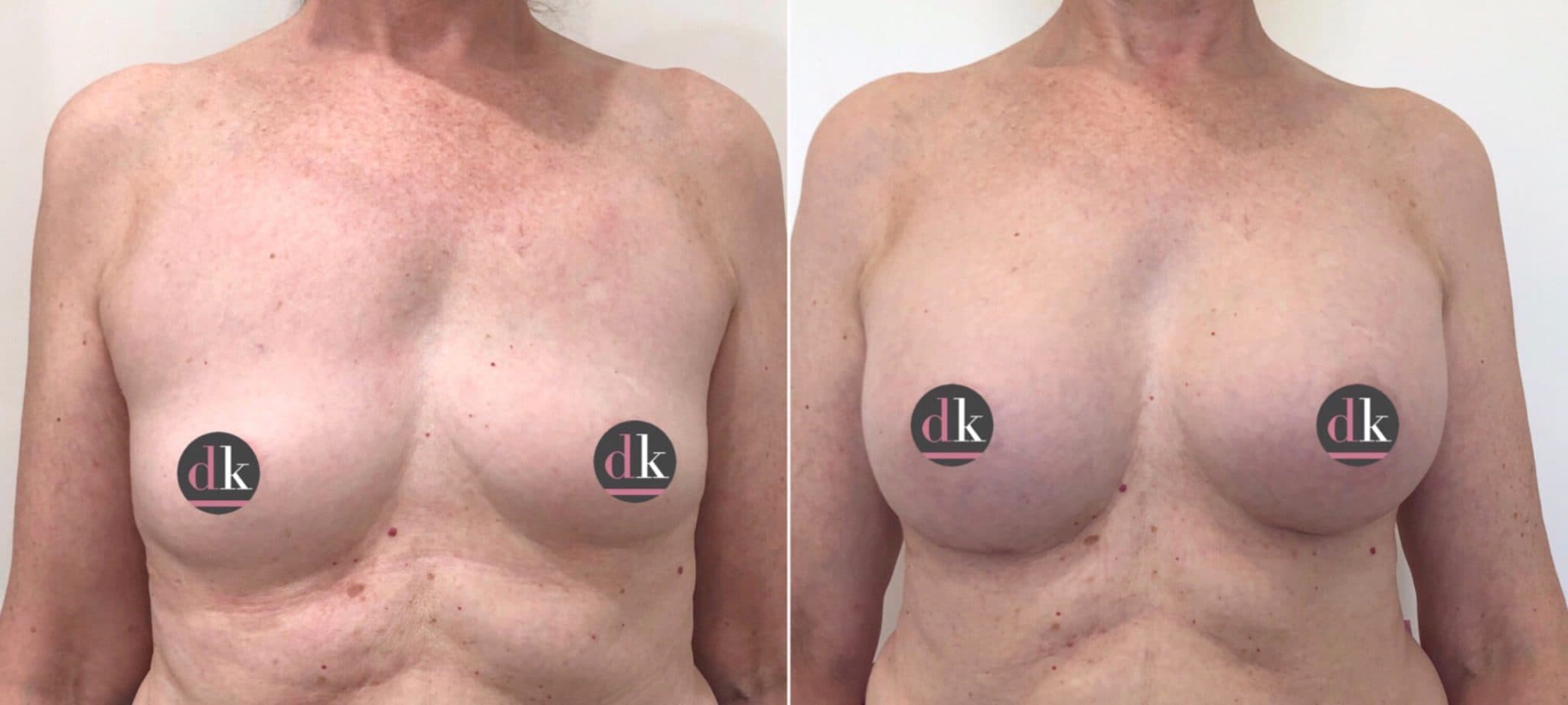 Before and after breast surgery by Dr. Dana Khuthaila, plastic surgeon in New York City — patient 60