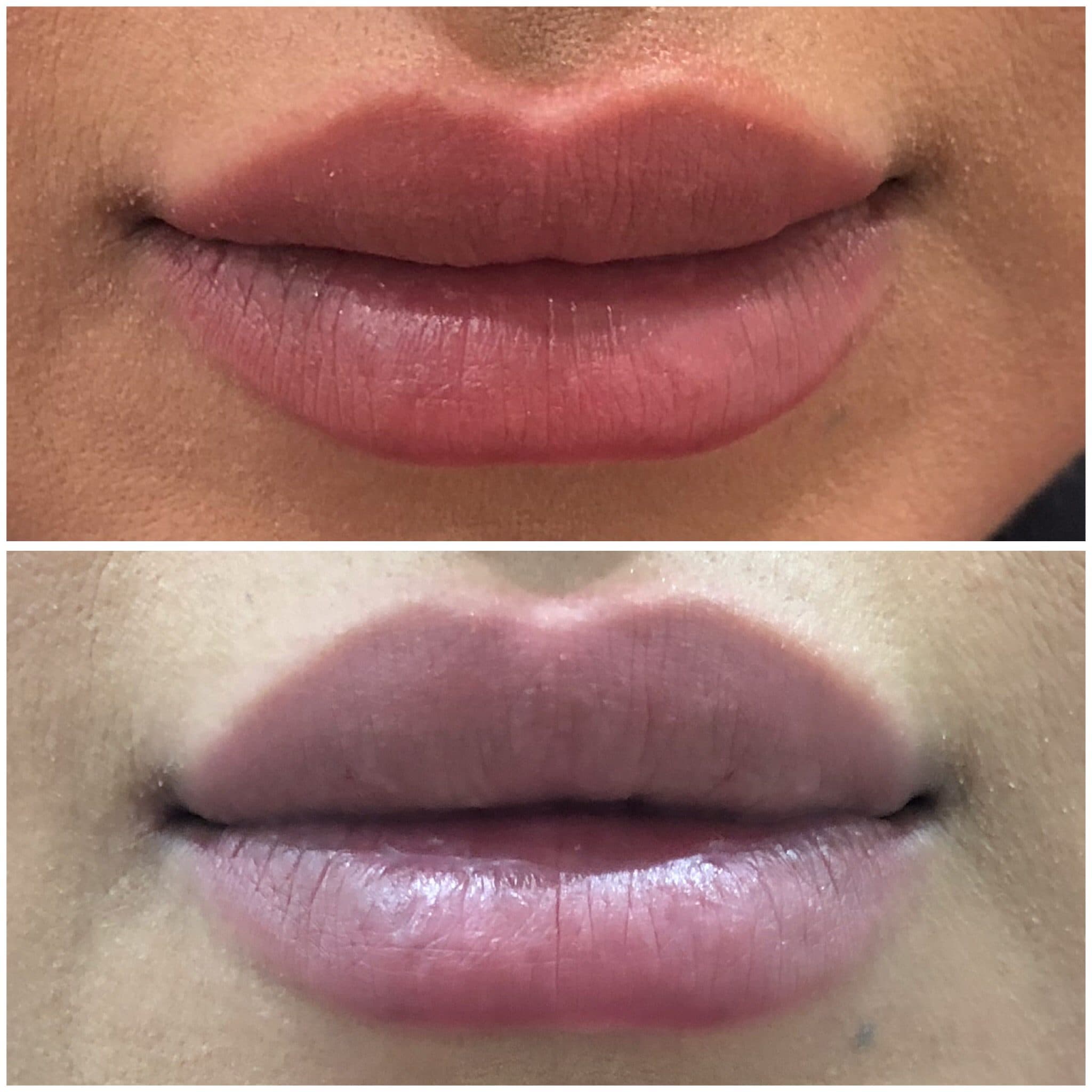 Before and after injectables surgery by Dr. Dana Khuthaila, plastic surgeon in New York City — patient 5