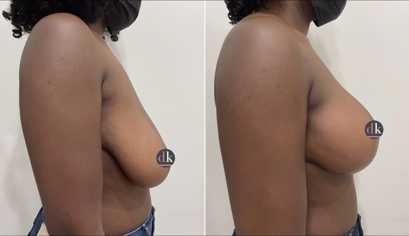 Before and after breast surgery by Dr. Dana Khuthaila, plastic surgeon in New York City — patient 9