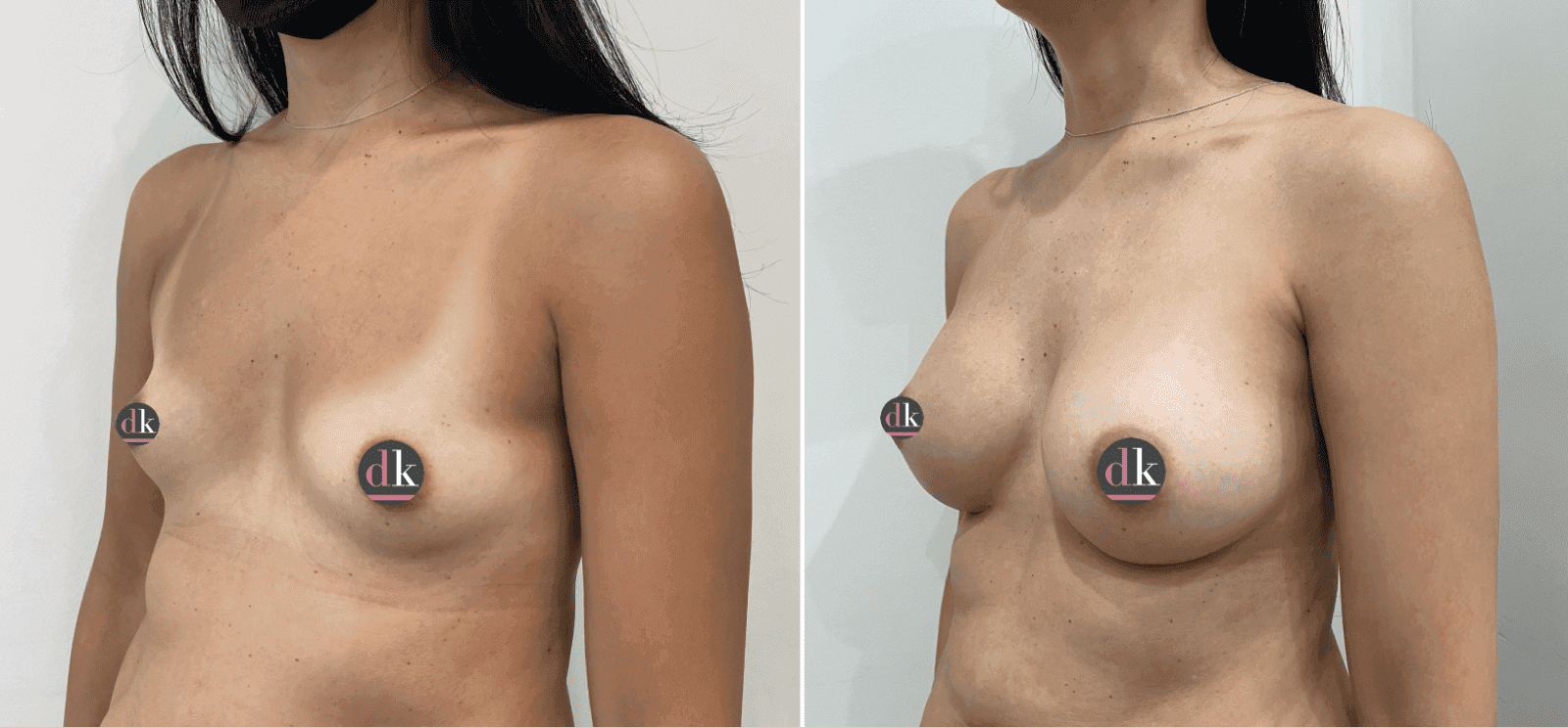 Before and after breast surgery by Dr. Dana Khuthaila, plastic surgeon in New York City — patient 40