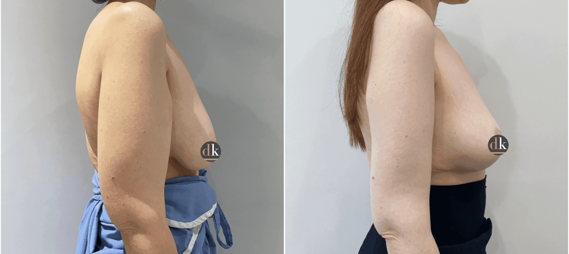 Before and after breast surgery by Dr. Dana Khuthaila, plastic surgeon in New York City — patient 16