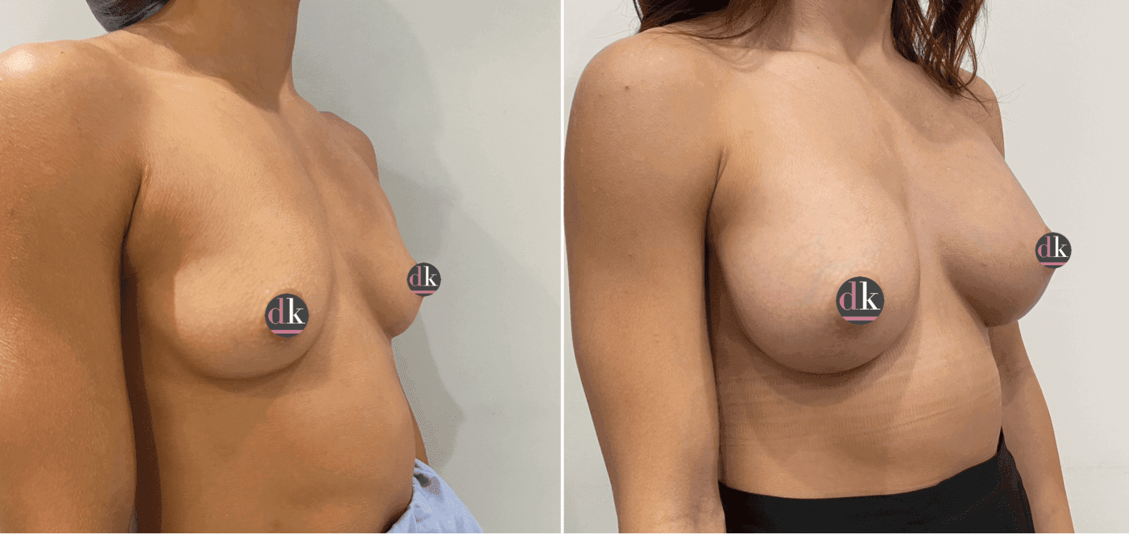 Before and after breast surgery by Dr. Dana Khuthaila, plastic surgeon in New York City — patient 73