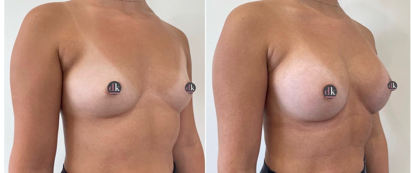 Before and after breast surgery by Dr. Dana Khuthaila, plastic surgeon in New York City — patient 70