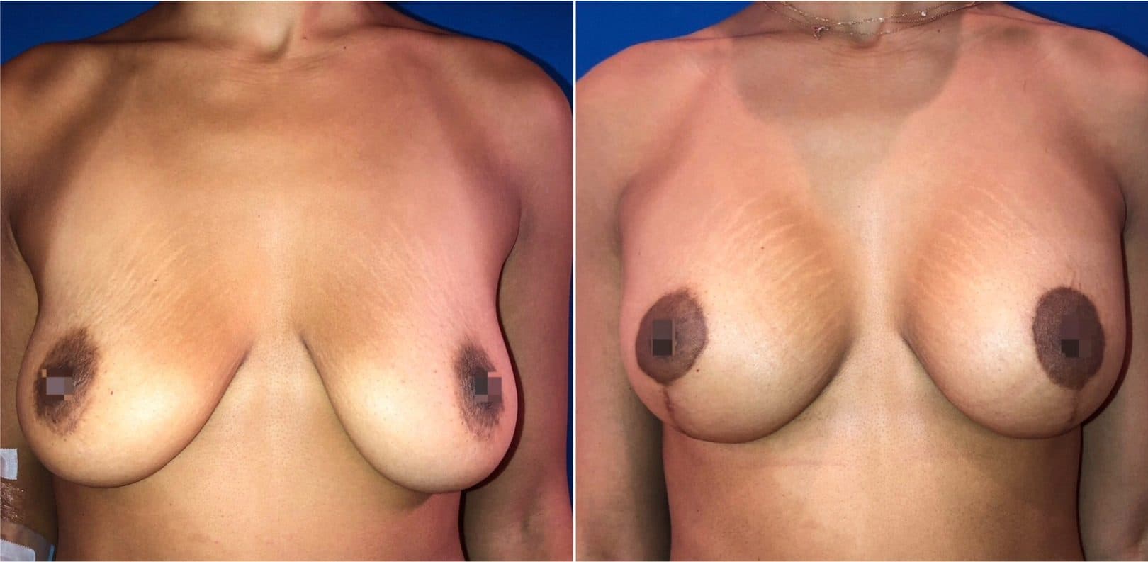 Before and after breast surgery by Dr. Dana Khuthaila, plastic surgeon in New York City — patient 68