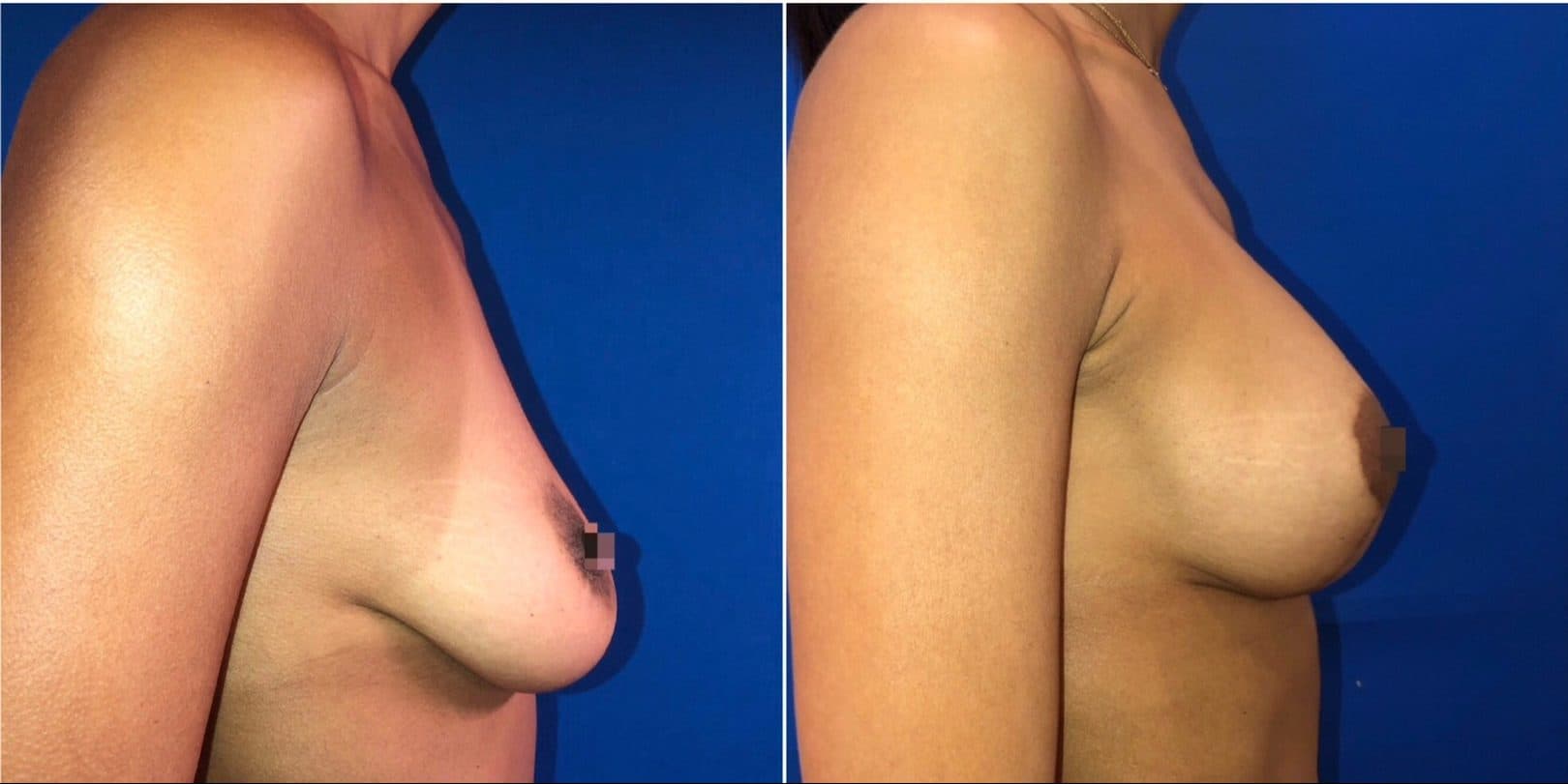 Before and after breast surgery by Dr. Dana Khuthaila, plastic surgeon in New York City — patient 69