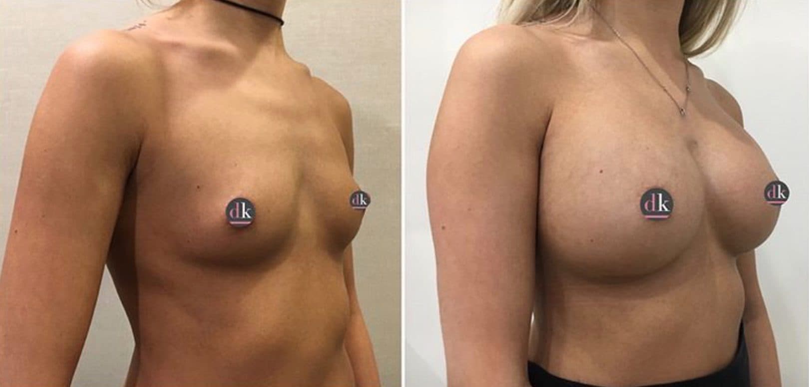 Before and after breast surgery by Dr. Dana Khuthaila, plastic surgeon in New York City — patient 71