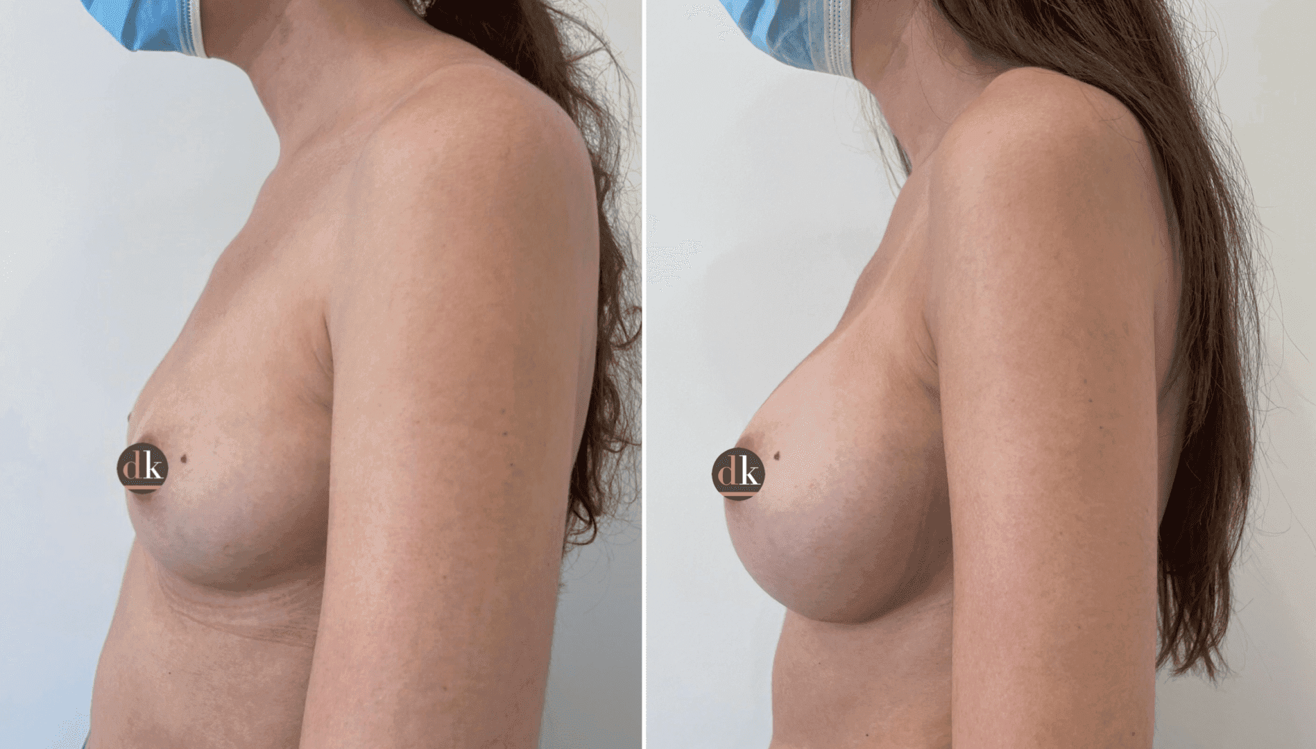 Before and after breast surgery by Dr. Dana Khuthaila, plastic surgeon in New York City — patient 34