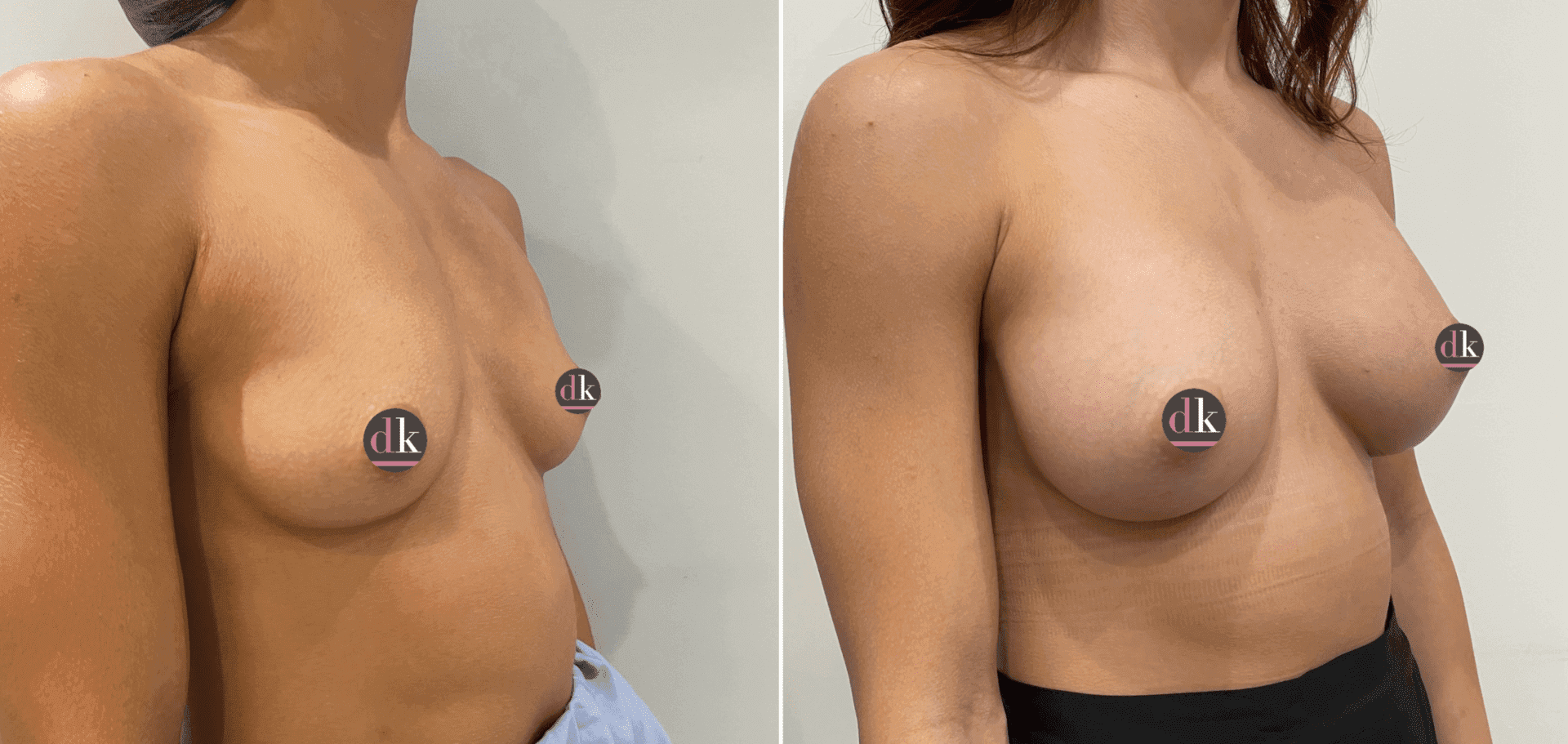 Before and after breast surgery by Dr. Dana Khuthaila, plastic surgeon in New York City — patient 36