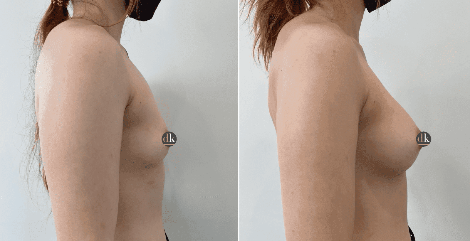 Before and after breast surgery by Dr. Dana Khuthaila, plastic surgeon in New York City — patient 42