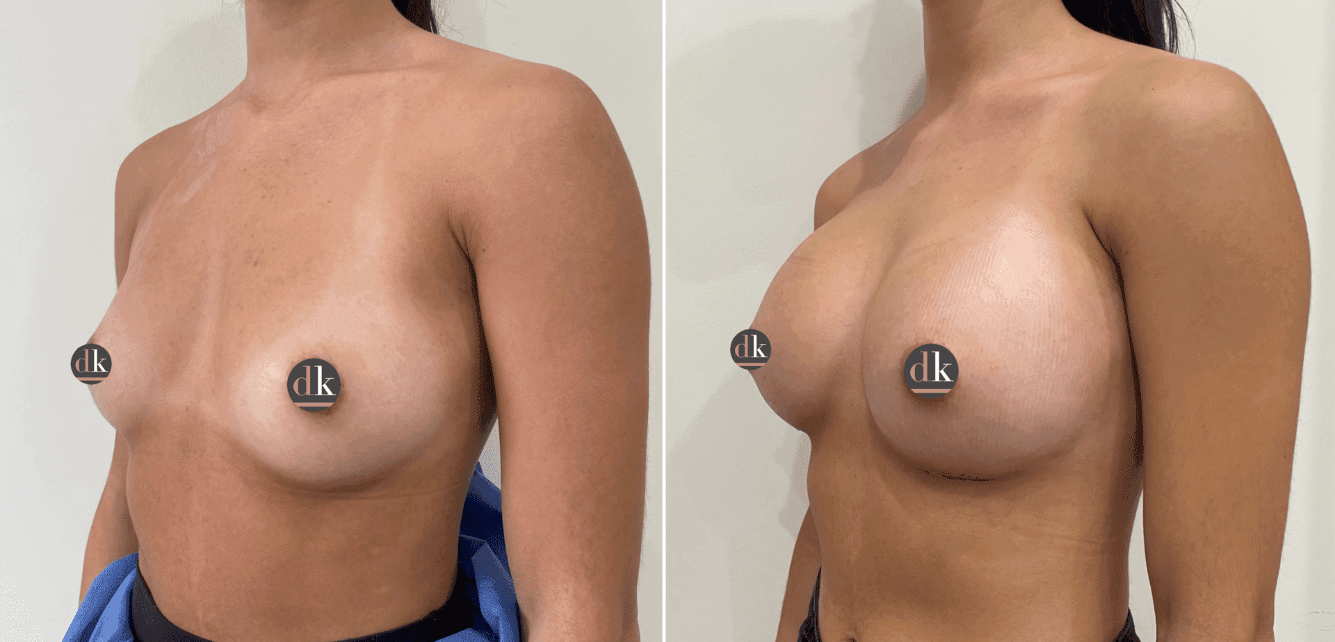 Before and after breast surgery by Dr. Dana Khuthaila, plastic surgeon in New York City — patient 39