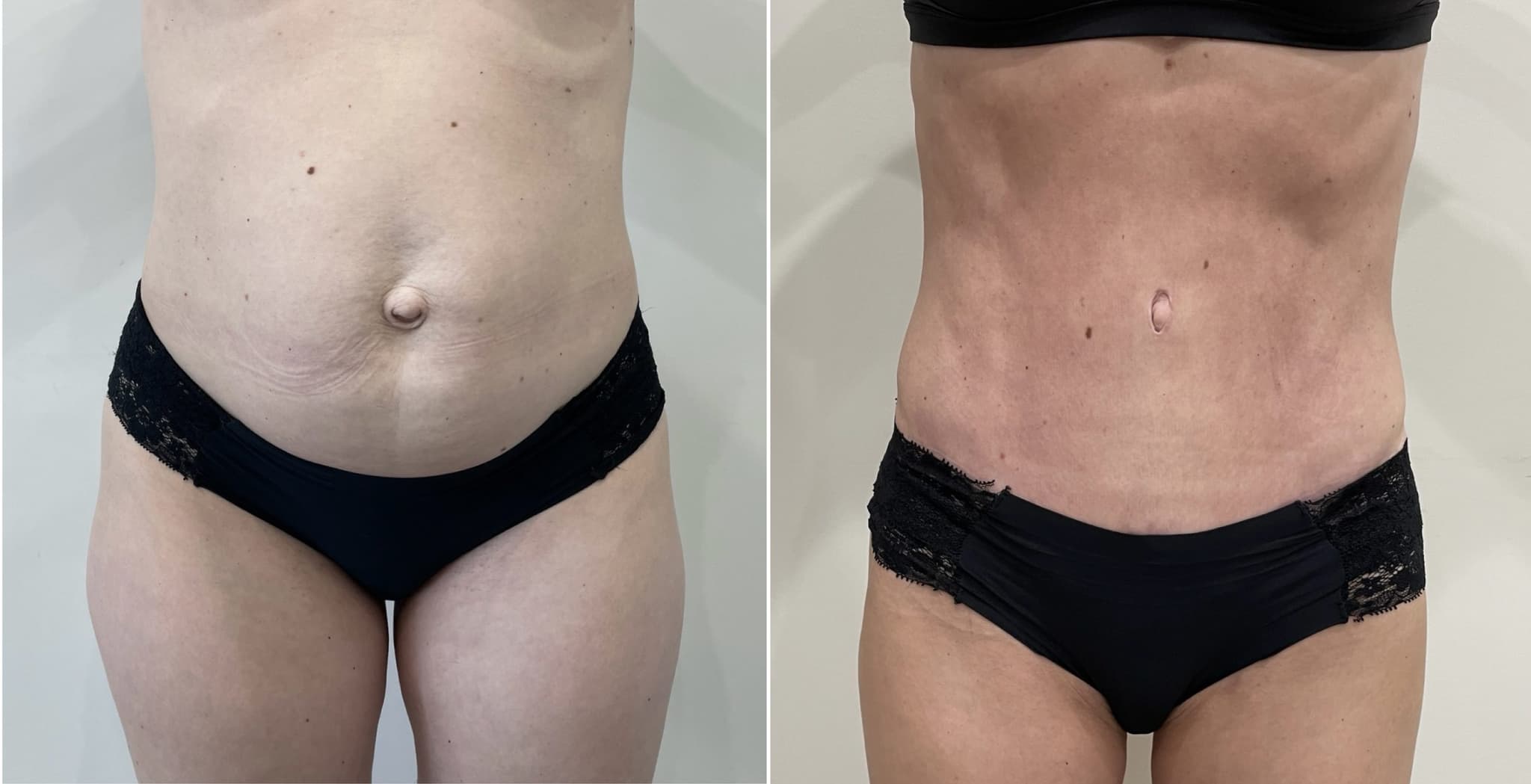 Before and after body surgery by Dr. Dana Khuthaila, plastic surgeon in New York City — patient 5