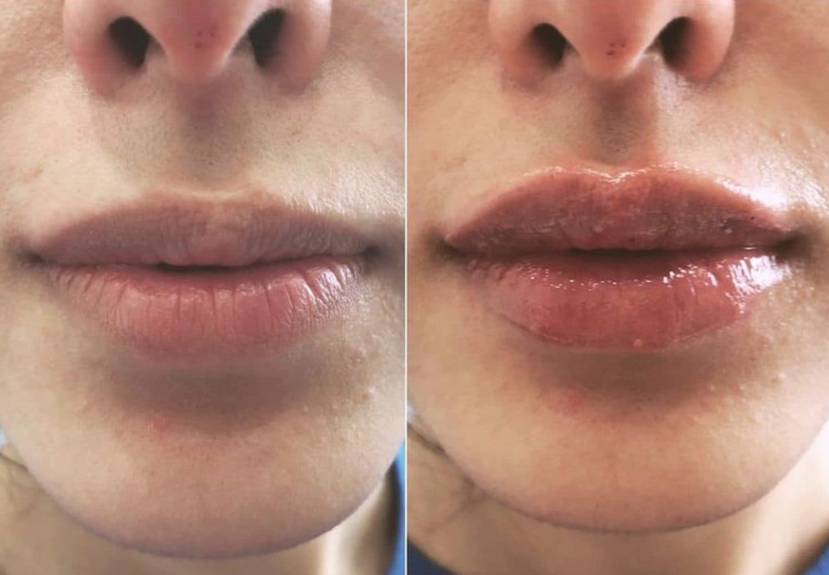 Before and after injectables surgery by Dr. Dana Khuthaila, plastic surgeon in New York City — patient 4