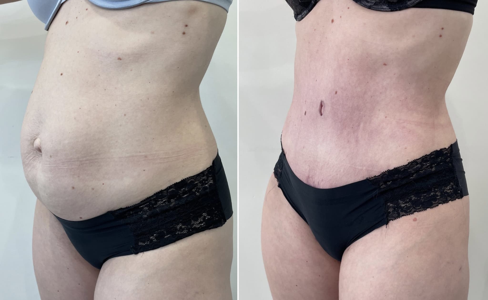 Before and after body surgery by Dr. Dana Khuthaila, plastic surgeon in New York City — patient 4