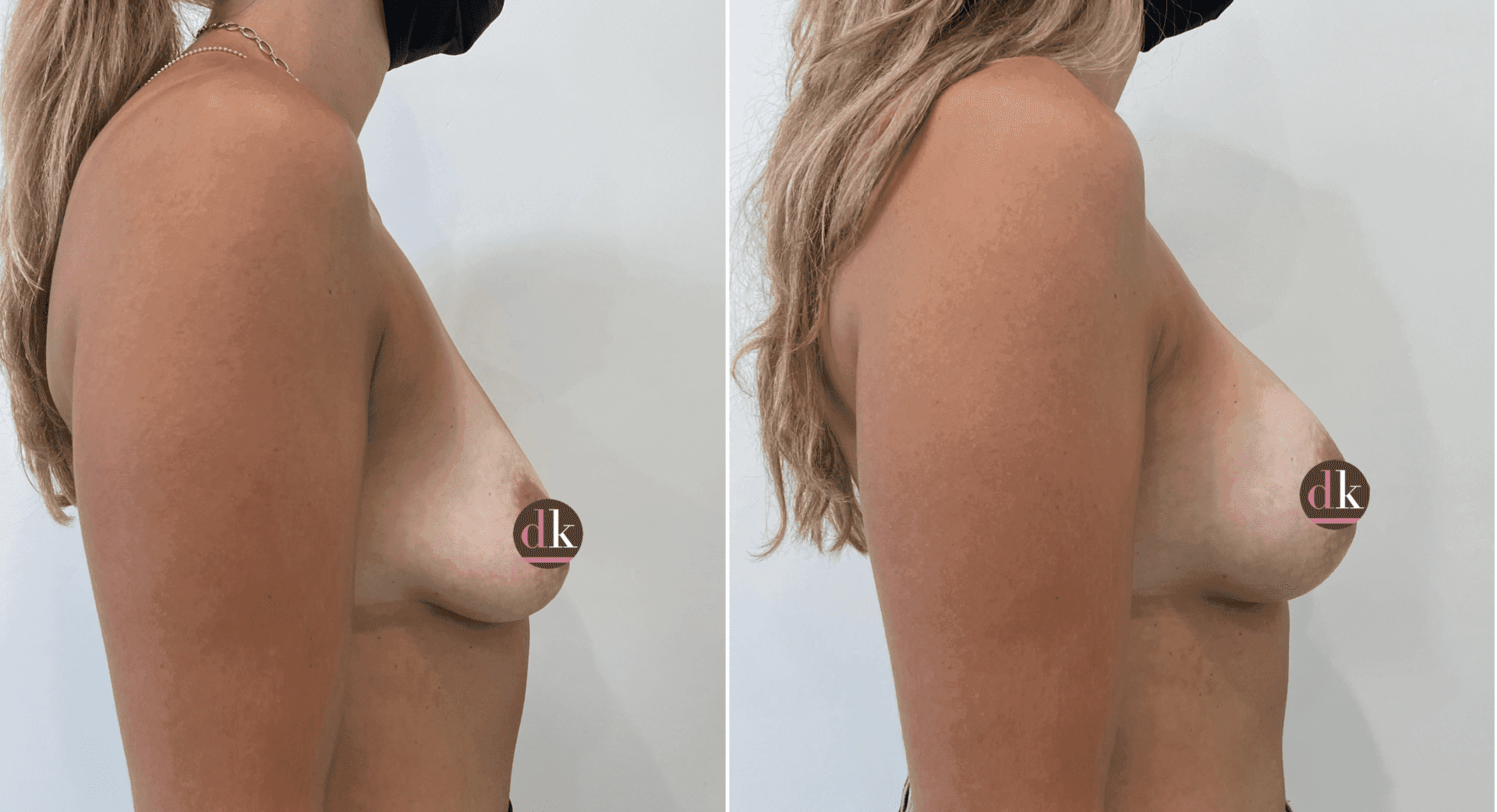 Before and after breast surgery by Dr. Dana Khuthaila, plastic surgeon in New York City — patient 76