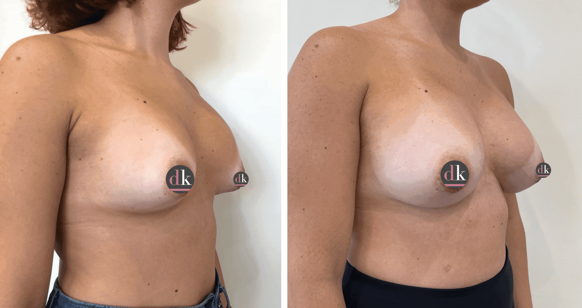 Before and after breast surgery by Dr. Dana Khuthaila, plastic surgeon in New York City — patient 83