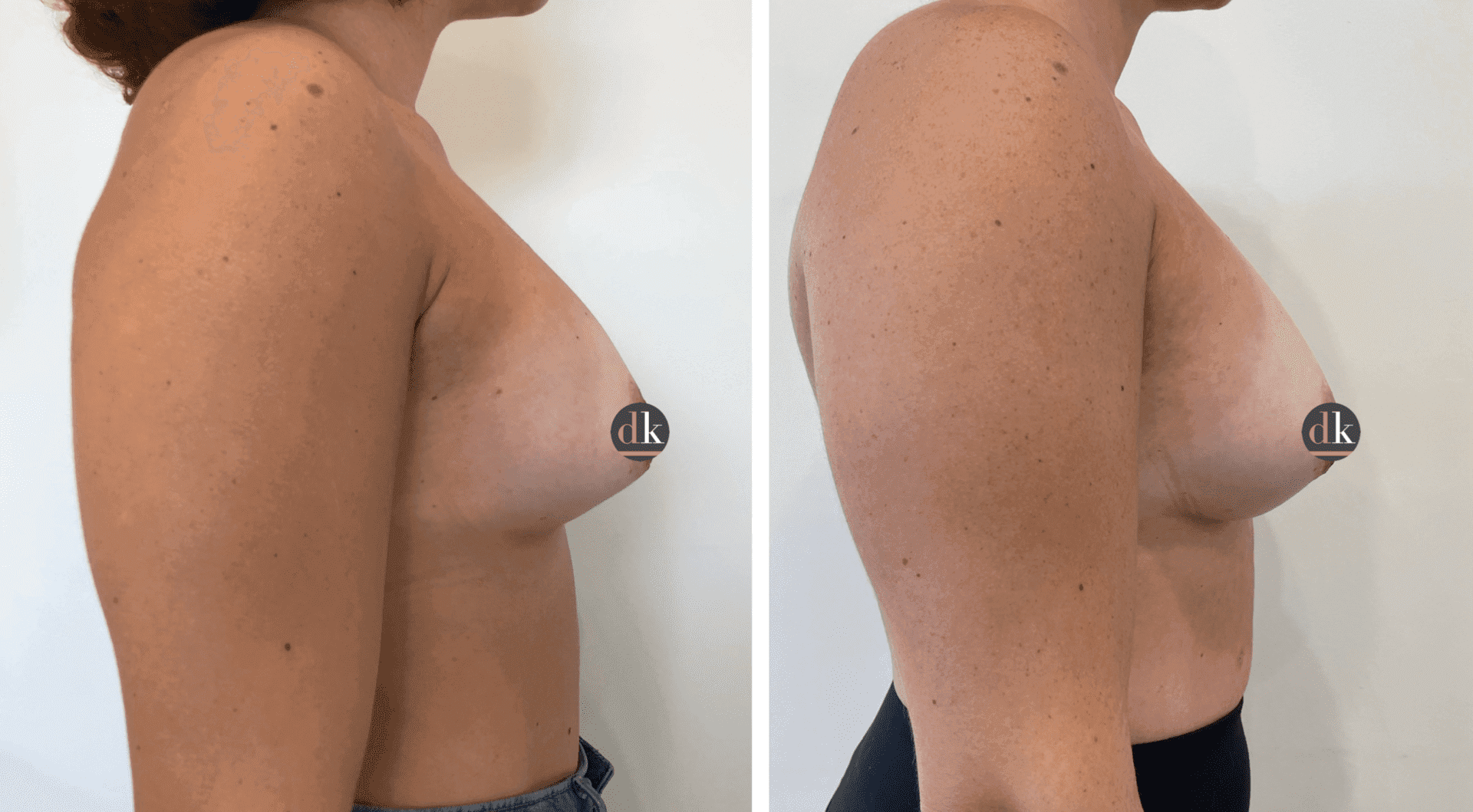 Before and after breast surgery by Dr. Dana Khuthaila, plastic surgeon in New York City — patient 84
