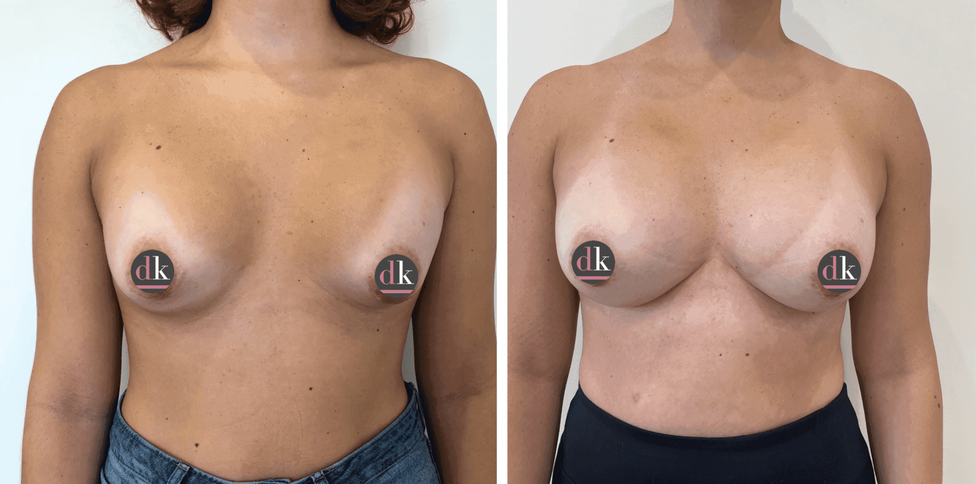 Before and after breast surgery by Dr. Dana Khuthaila, plastic surgeon in New York City — patient 85