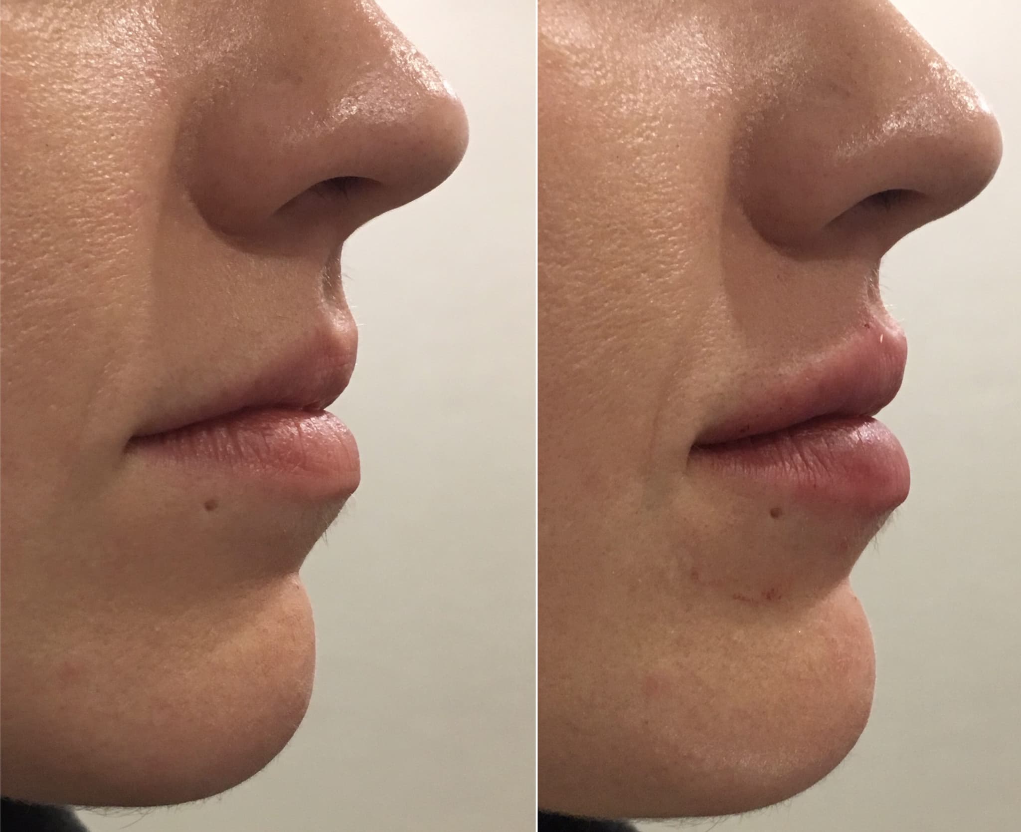 Before and after injectables surgery by Dr. Dana Khuthaila, plastic surgeon in New York City — patient 6