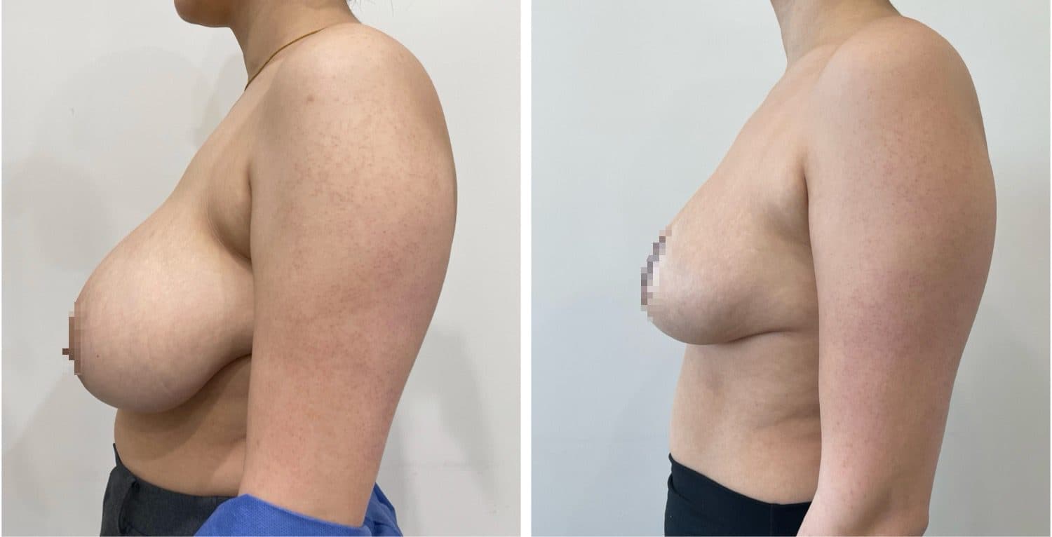 Before and after breast surgery by Dr. Dana Khuthaila, plastic surgeon in New York City — patient 17