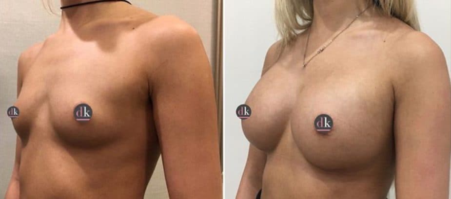 Before and after breast surgery by Dr. Dana Khuthaila, plastic surgeon in New York City — patient 88