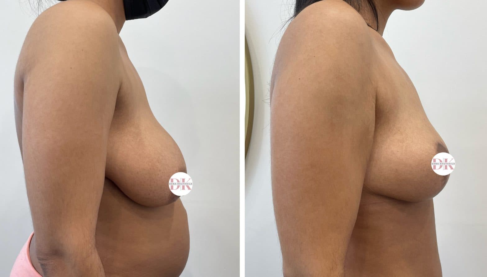 Before and after breast surgery by Dr. Dana Khuthaila, plastic surgeon in New York City — patient 93