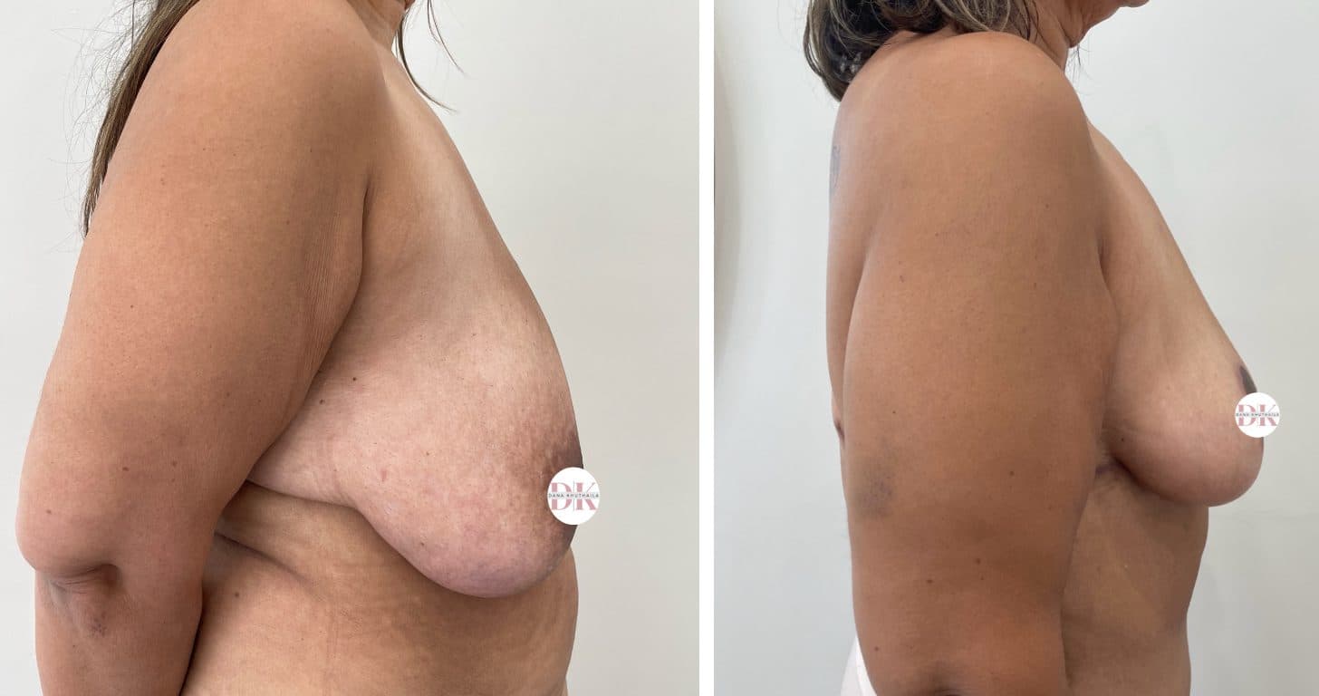 Before and after breast surgery by Dr. Dana Khuthaila, plastic surgeon in New York City — patient 11