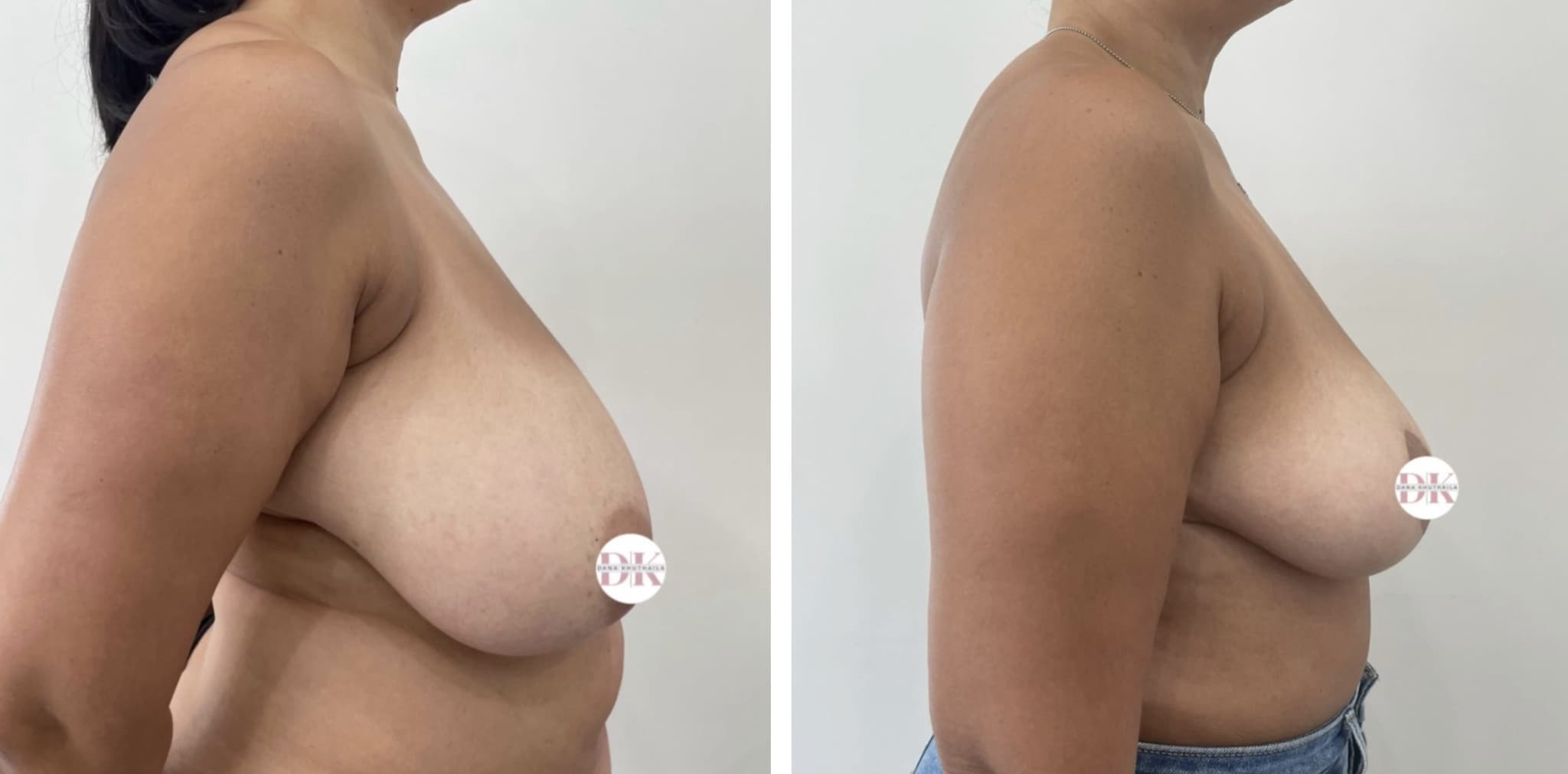 Before and after breast surgery by Dr. Dana Khuthaila, plastic surgeon in New York City — patient 3