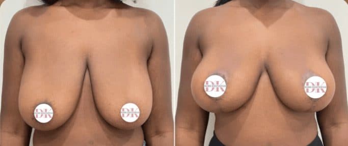 Before and after breast surgery by Dr. Dana Khuthaila, plastic surgeon in New York City — patient 8