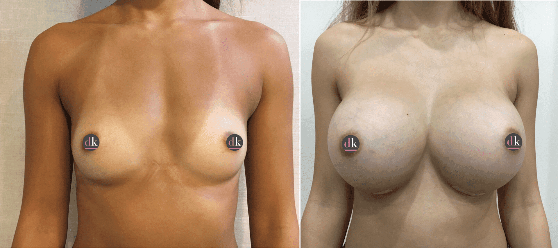 Before and after breast surgery by Dr. Dana Khuthaila, plastic surgeon in New York City — patient 59