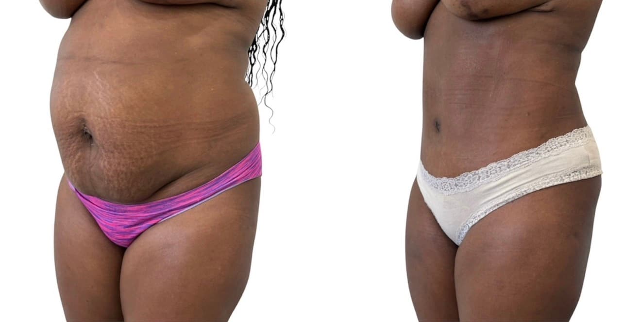 Before and after body surgery by Dr. Dana Khuthaila, plastic surgeon in New York City — patient 28