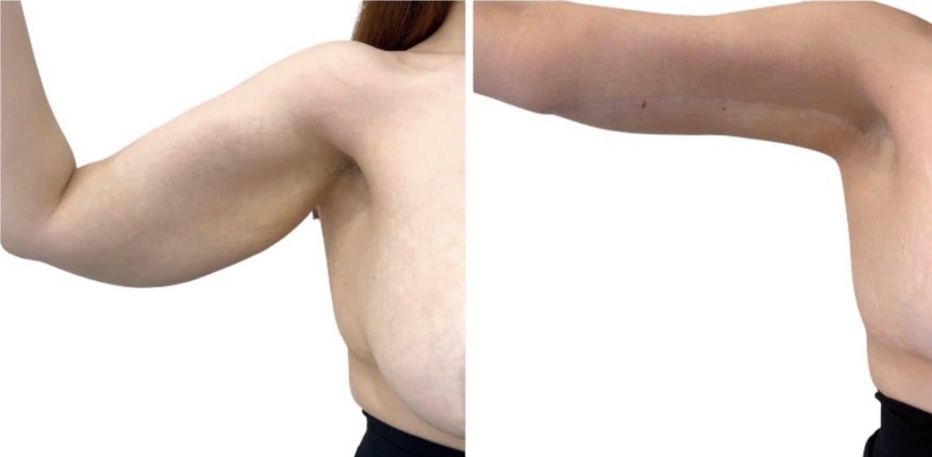 Before and after body surgery by Dr. Dana Khuthaila, plastic surgeon in New York City — patient 45