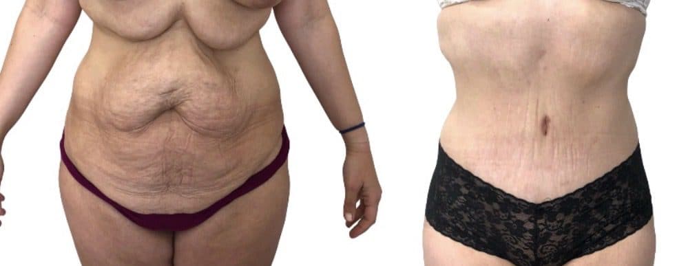 Before and after body surgery by Dr. Dana Khuthaila, plastic surgeon in New York City — patient 16