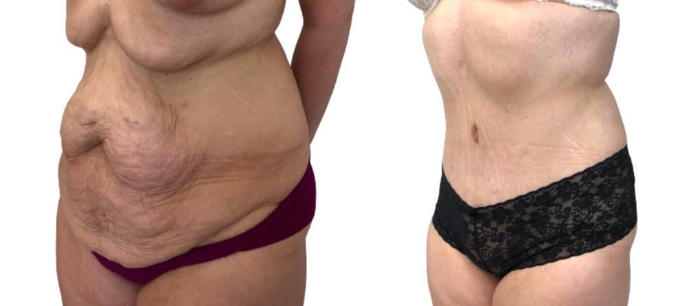 Before and after body surgery by Dr. Dana Khuthaila, plastic surgeon in New York City — patient 15
