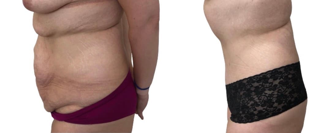 Before and after body surgery by Dr. Dana Khuthaila, plastic surgeon in New York City — patient 14