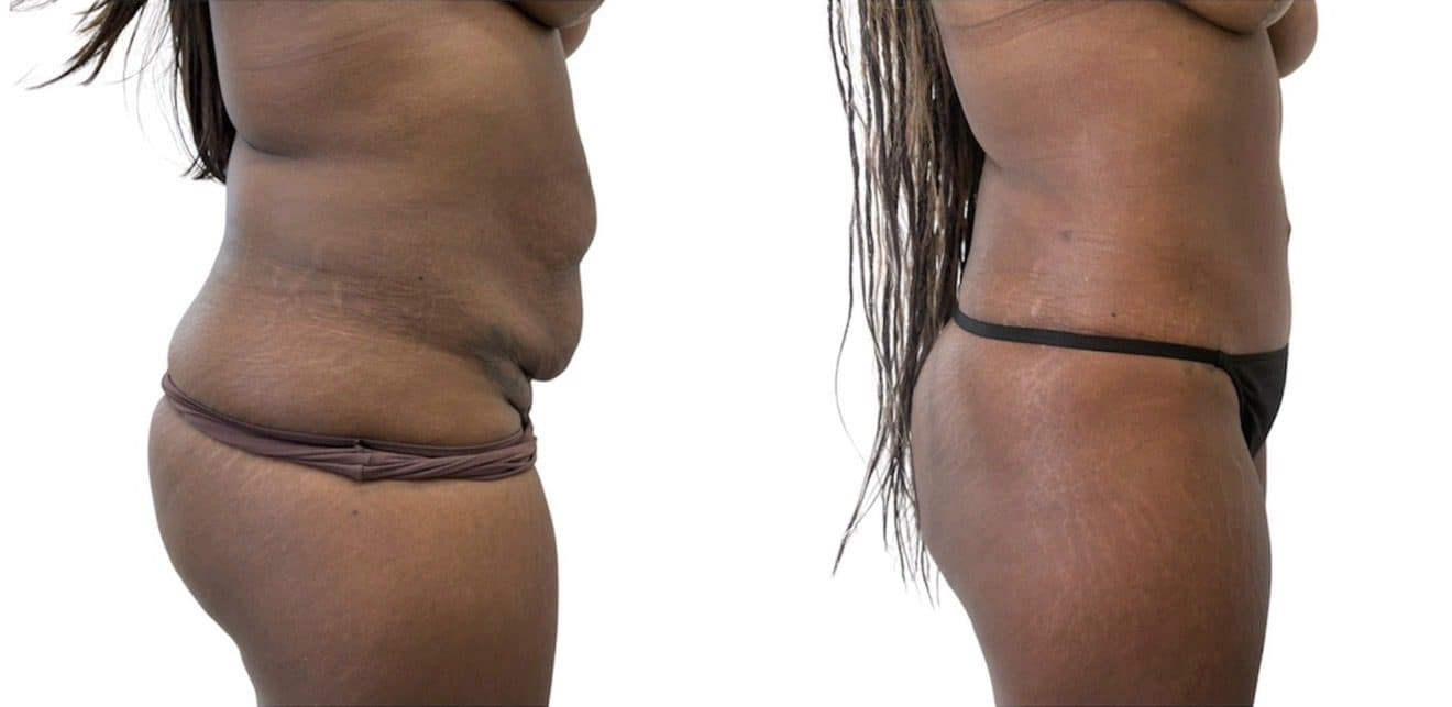 Before and after body surgery by Dr. Dana Khuthaila, plastic surgeon in New York City — patient 10