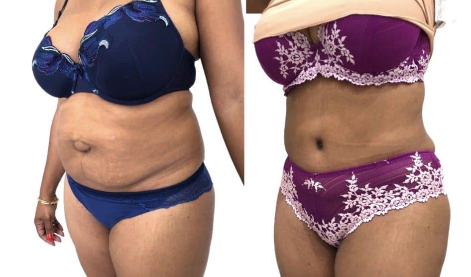 Before and after body surgery by Dr. Dana Khuthaila, plastic surgeon in New York City — patient 8