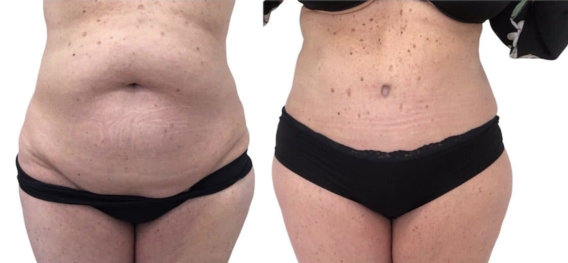 Before and after body surgery by Dr. Dana Khuthaila, plastic surgeon in New York City — patient 37