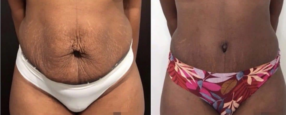 Before and after body surgery by Dr. Dana Khuthaila, plastic surgeon in New York City — patient 44