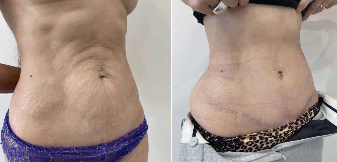 Before and after body surgery by Dr. Dana Khuthaila, plastic surgeon in New York City — patient 22