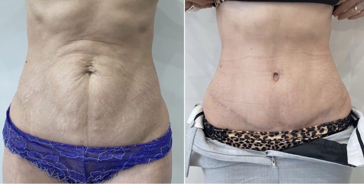 Before and after body surgery by Dr. Dana Khuthaila, plastic surgeon in New York City — patient 21