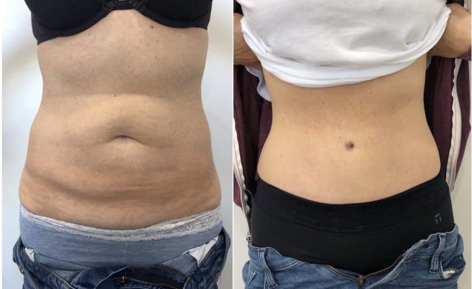 Before and after body surgery by Dr. Dana Khuthaila, plastic surgeon in New York City — patient 25