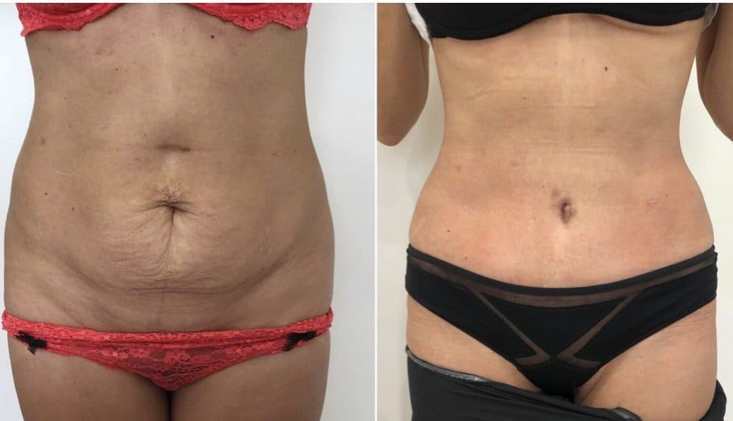 Before and after body surgery by Dr. Dana Khuthaila, plastic surgeon in New York City — patient 23