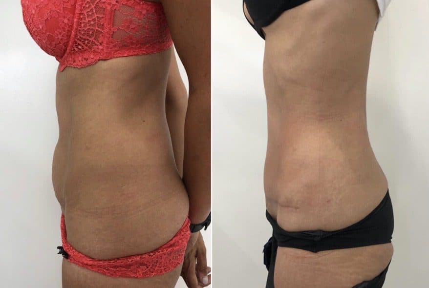 Before and after body surgery by Dr. Dana Khuthaila, plastic surgeon in New York City — patient 24
