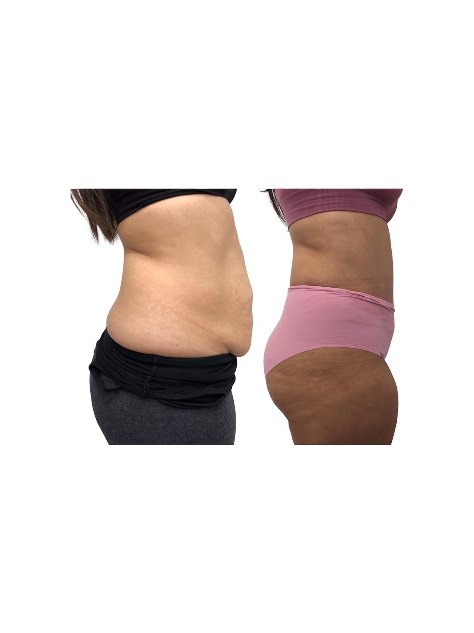 Before and after body surgery by Dr. Dana Khuthaila, plastic surgeon in New York City — patient 30