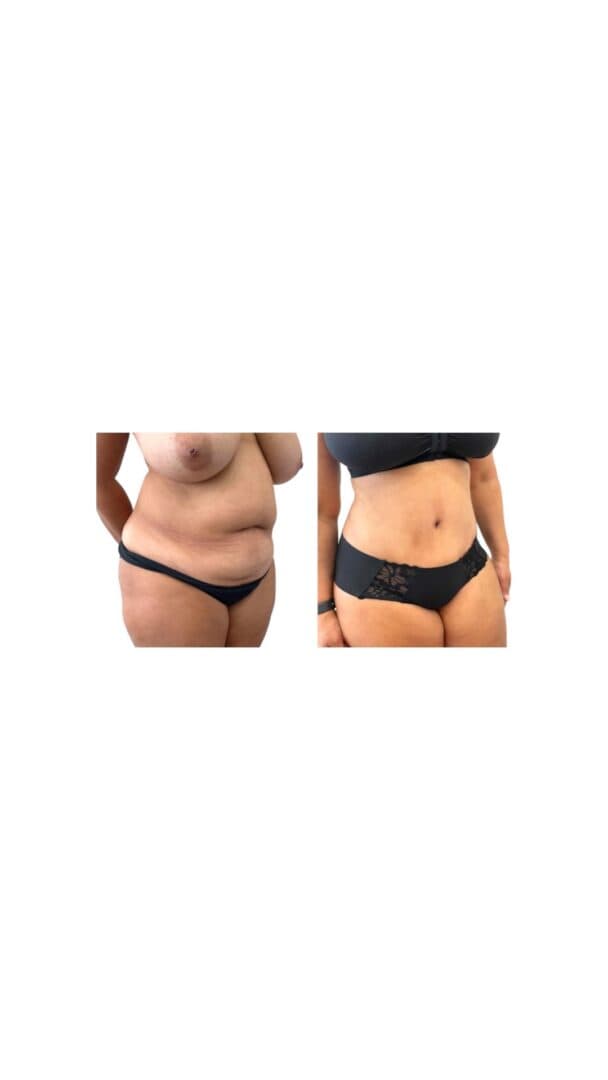Before and after body surgery by Dr. Dana Khuthaila, plastic surgeon in New York City — patient 32