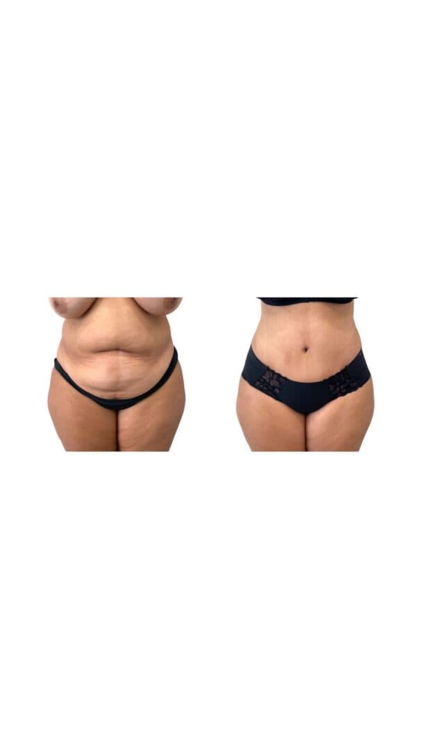 Before and after body surgery by Dr. Dana Khuthaila, plastic surgeon in New York City — patient 31